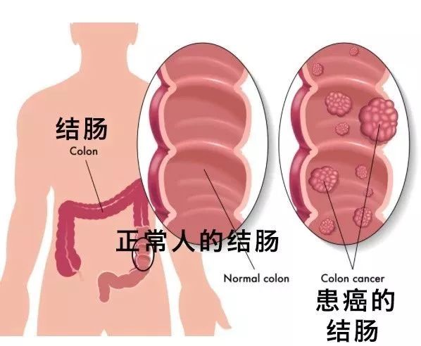 不是癌症的恶性肿瘤有哪些,不是癌症的绝症有哪些