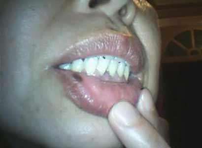 嘴唇上有黑斑是有癌症了吗,嘴唇有黑斑是肠道有病吗