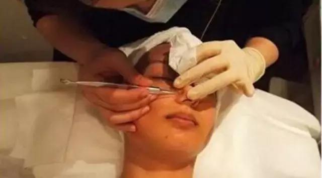 去除闭口有什么最简单的好办法,如何简单有效去闭口