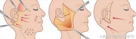 面部大小拉皮手术的区别,大拉皮手术面部多久恢复自然