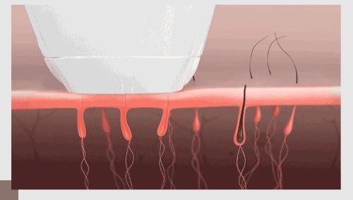 5分钟搞定20多年的毛儿!连小胡子都不见了