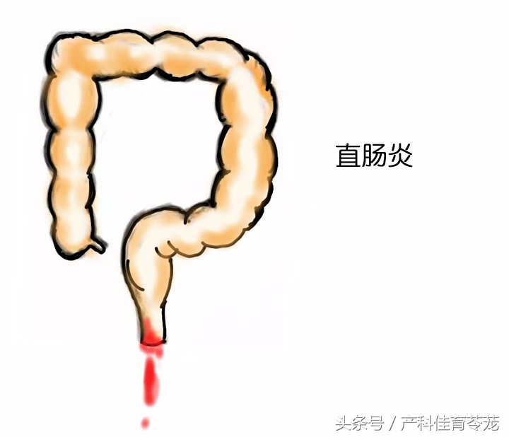 沙眼衣原体感染尿道症状,生殖器沙眼衣原体感染怎么治疗