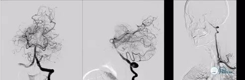 基底动脉闭合手术,基底动脉闭塞取栓一直昏睡