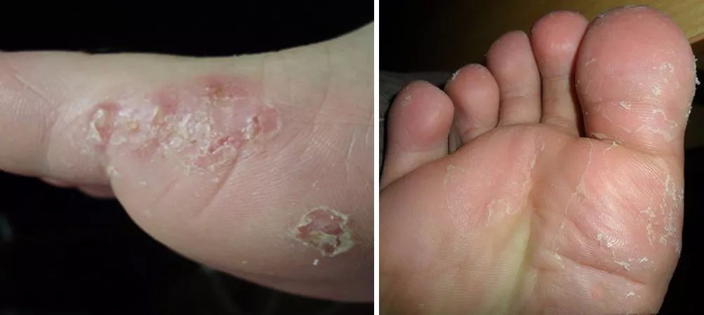 脚气脚臭有救了！有了这块韩国嫩足皂，轻轻一洗，杀菌治脚气，告别瘙痒，连死皮都不见了