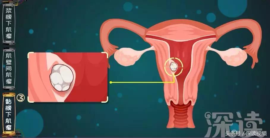 子宫肌瘤在哪个地方影响怀孕,子宫肌瘤剔除怎么还有东西流出来
