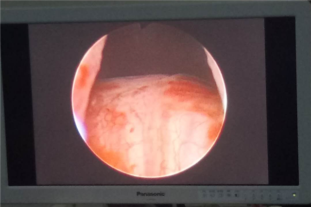 前列腺增生微创手术需要冲洗膀胱,前列腺增生微创手术尿道损伤