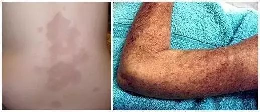 皮肤肿物门诊能报销吗,皮肤长小疙瘩做冷冻医保能报吗