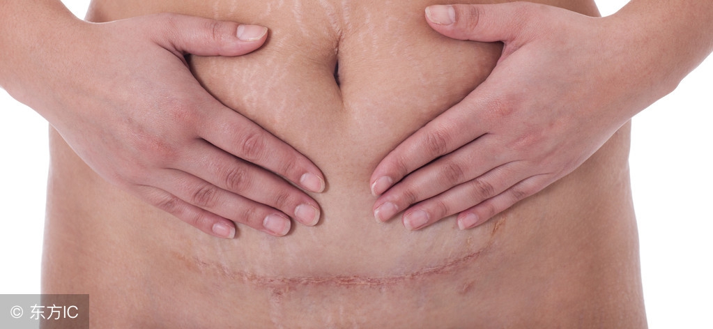 剖宫产后瘢痕组织增生,剖宫产疤痕已经增生怎么处理