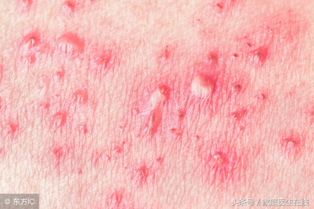 带状疱疹如何好得快,如何让带状疱疹好得更快