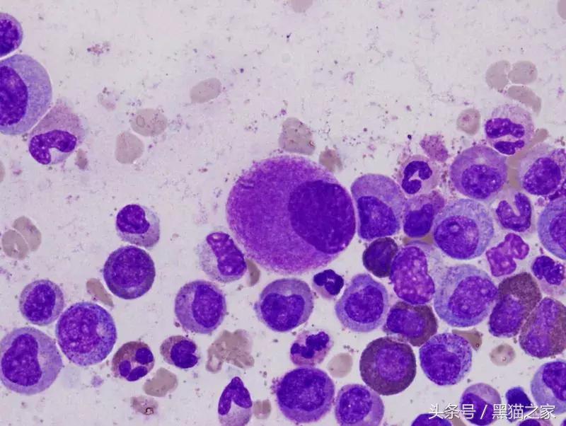 印度仿制白血病特效药,专治疗白血病的印度仿制药