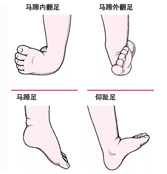 女子穿洞洞鞋脚被鞋划伤,小女孩穿洞洞鞋脚被卡在电梯内