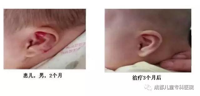 后脑勺红色印记是胎记还是血管瘤,皮肤有红色印记是血管瘤还是胎记