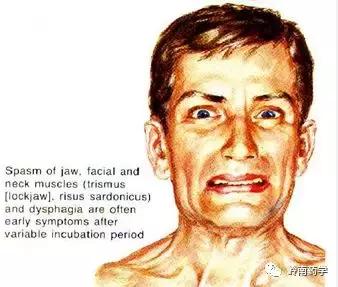 除了打破伤风针有什么药可以预防,在伤口处贴创可贴能预防破伤风吗