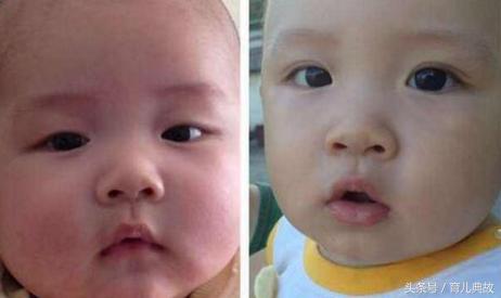 一岁宝宝双眼皮突然变内双了,双眼皮一觉醒来变成单眼皮怎么办