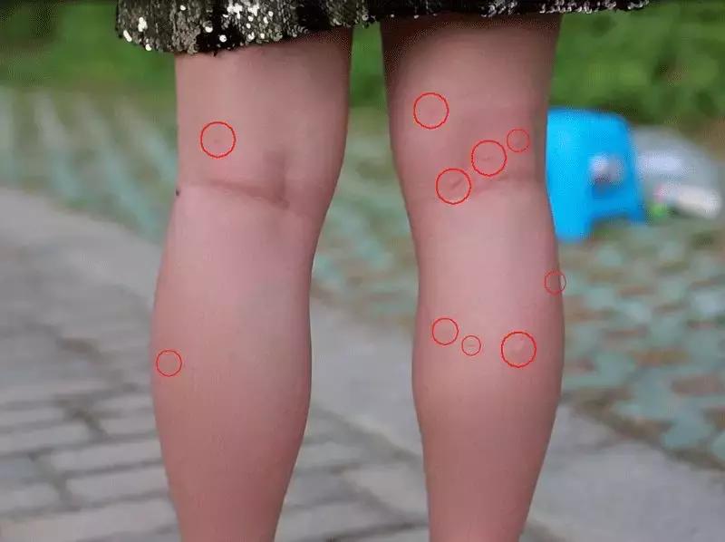 宝宝被蚊子叮了怎么止痒消肿？测评后我发现网红产品竟然最有用！