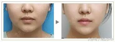 顽固性易胖体质怎么瘦下去,145斤易胖体质能瘦下来吗