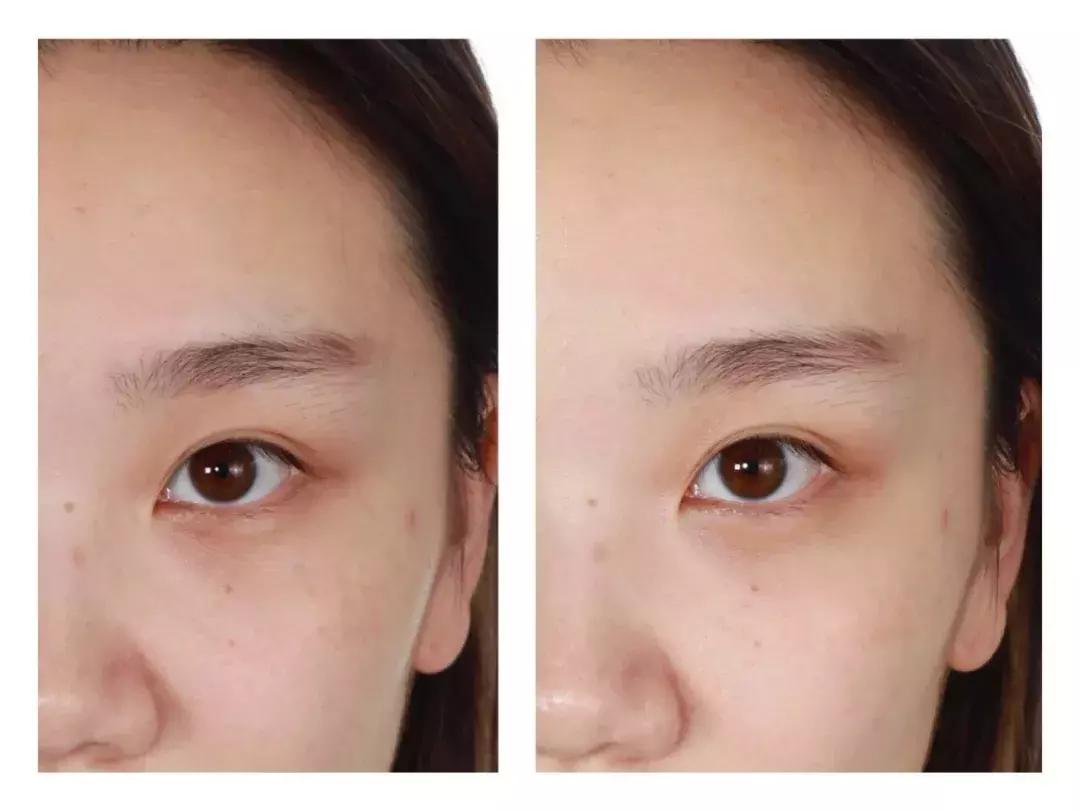 什么样的纯露可以消除痘印,有闭口痘痘用哪款纯露