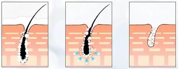 脱毛神器有哪些平价的好用,比较推荐的脱毛神器有哪些