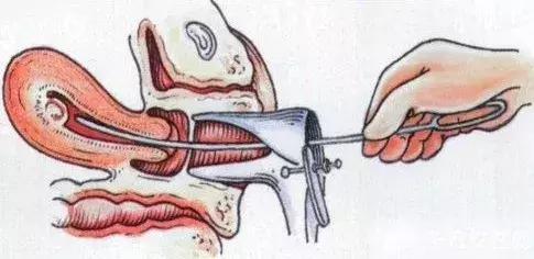 无痛人流是真的一点感觉都没有吗,无痛人流安全吗会不会造成不孕