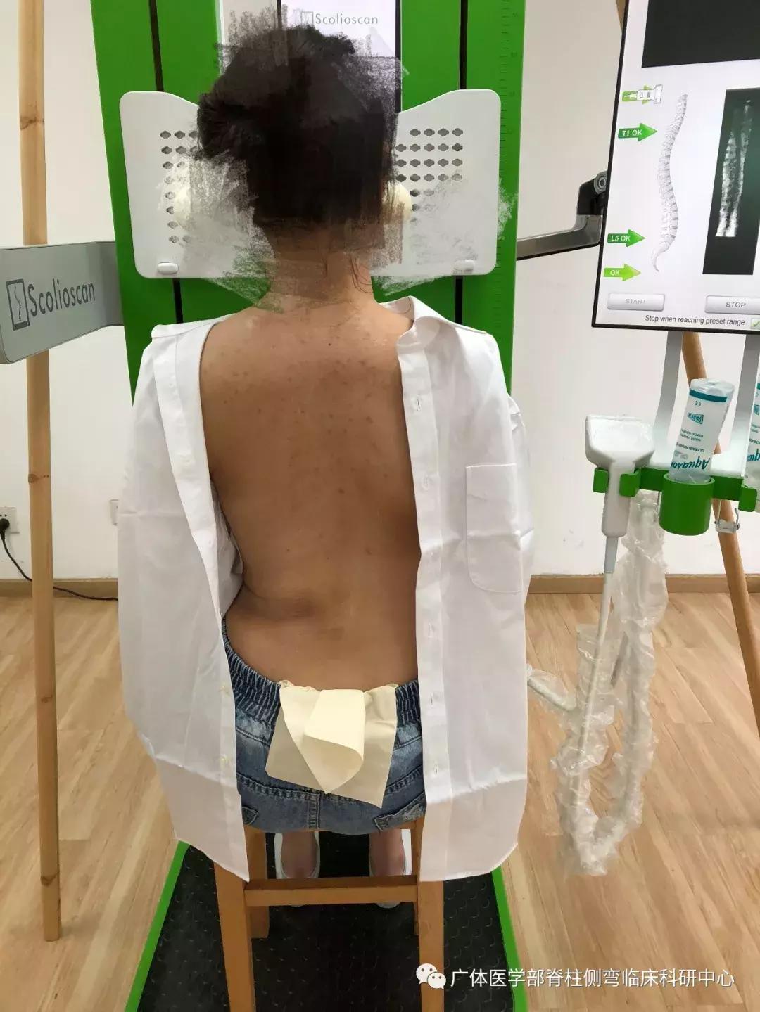 Scolioscan三维超声实现姿势矫正可视化（三）——近胸弯