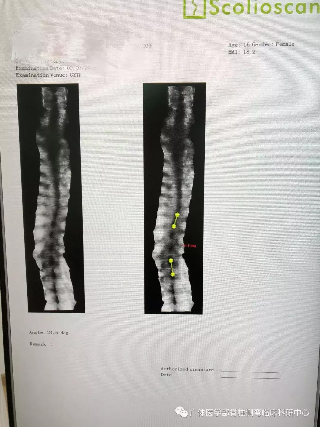 Scolioscan三维超声实现姿势矫正可视化（三）——近胸弯