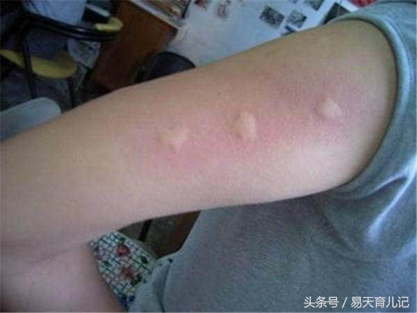 宝宝身上起小红疙瘩，父母注意啦，这可不是蚊子包，别不当回事儿