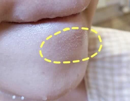 下巴绷紧皮里面有好多颗粒,下巴有白色颗粒凸起怎么解决
