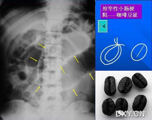 10种经典肠道影像征象：绳征、串珠征、螺纹征……你听过几个？