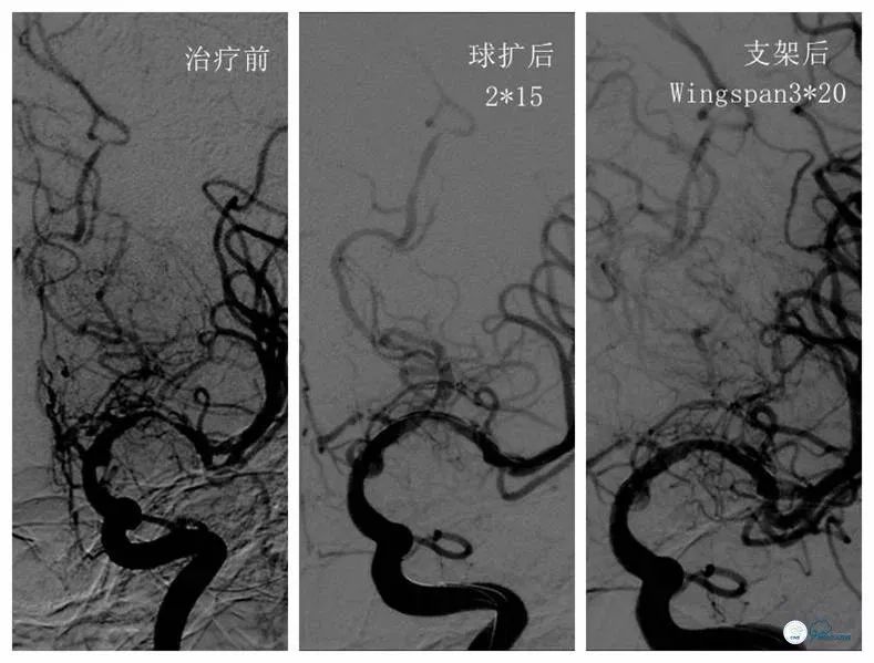 大脑中动脉支架术后再狭窄的几率,天坛医院介入脑血管手术