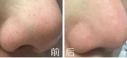 祛黑头越做毛孔越大,特别多的黑头毛孔也特别大怎么办