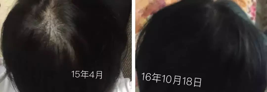 脱发真的很可怕,脱发可怕吗