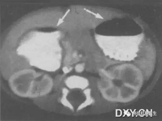 10种经典肠道影像征象详解