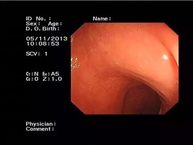 缺血性结肠炎内镜图片,缺血性肠炎肠镜表现