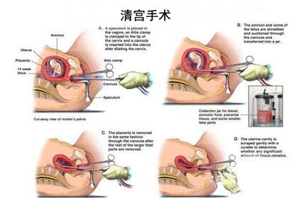 清宫真的痛到承受不了吗,清宫术到底多痛