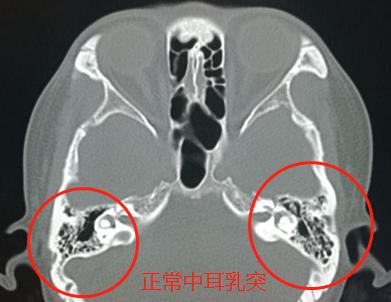 孩子听力下降的最佳恢复方法,鼻窦炎引起中耳炎听力下降怎么治