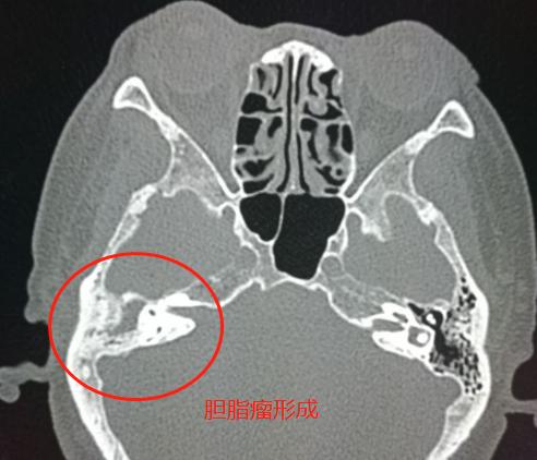 小孩游泳怎么预防中耳炎,儿童游泳如何预防中耳炎