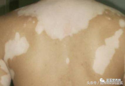 怎么判断孩子斑点是不是白癜风,宝宝身上长白斑是缺什么