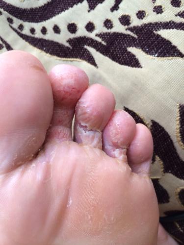 脚气病的预防方法有哪些,脚气的预防