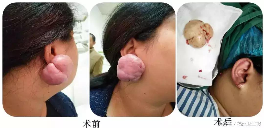 21岁女孩打耳洞后耳朵长出鸽子蛋,打耳洞长出肉疙瘩的概率多大