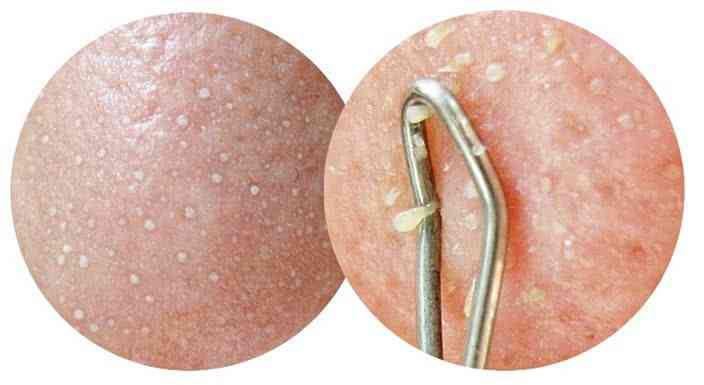 脸上有白米粒该用什么产品,脸上抠出来白色的东西是什么