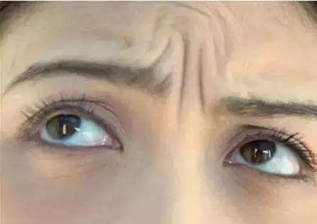 女人30岁脸上皱纹怎么除皱最安全,30岁以上女人祛皱纹妙招