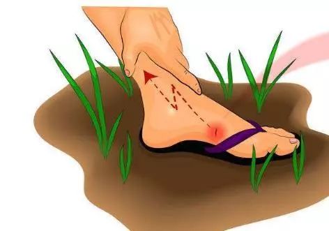 伤口预防破伤风最可靠的措施,多大的伤口才能导致破伤风感染