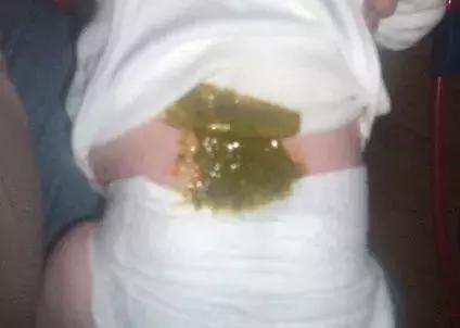 儿童腹泻家长要学会正确护理,家长应如何护理腹泻的小朋友