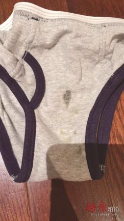 华童*体下**红肿流脓称被幼儿园同伴打伤