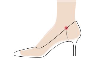 女孩脚肿瘤,25岁女性脚趾长肿瘤