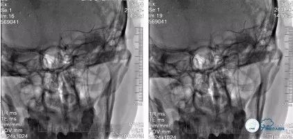 颈动脉闭塞介入治疗的风险,慢性动脉闭塞症病例