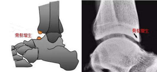 足球世界杯护踝,世界杯踢足球护腿