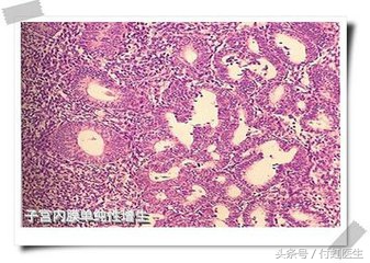 月经正常为何医生诊断月经不调,内膜增生息肉是什么原因引起呢