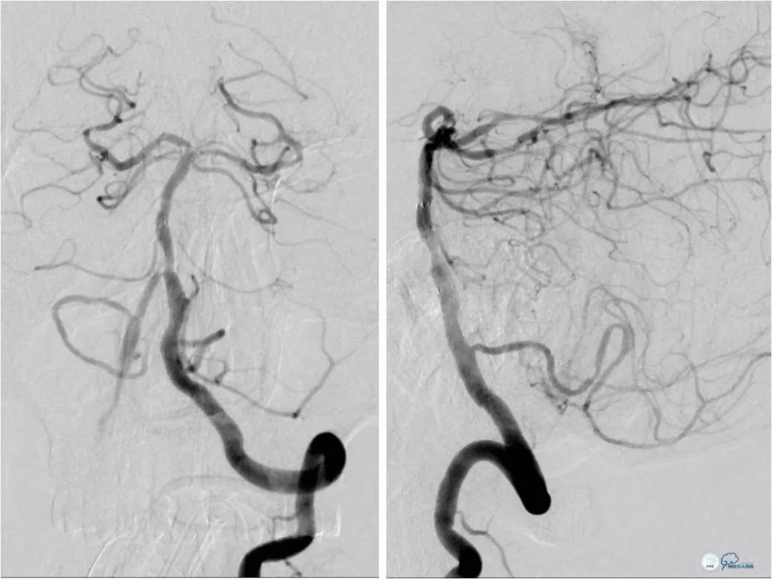 天坛周记｜左椎动脉开口及基底动脉串联狭窄血管内介入治疗1例