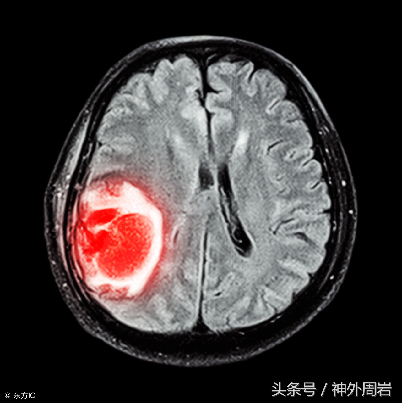 细胞免疫治疗有用吗,脑瘤可以用免疫治疗吗